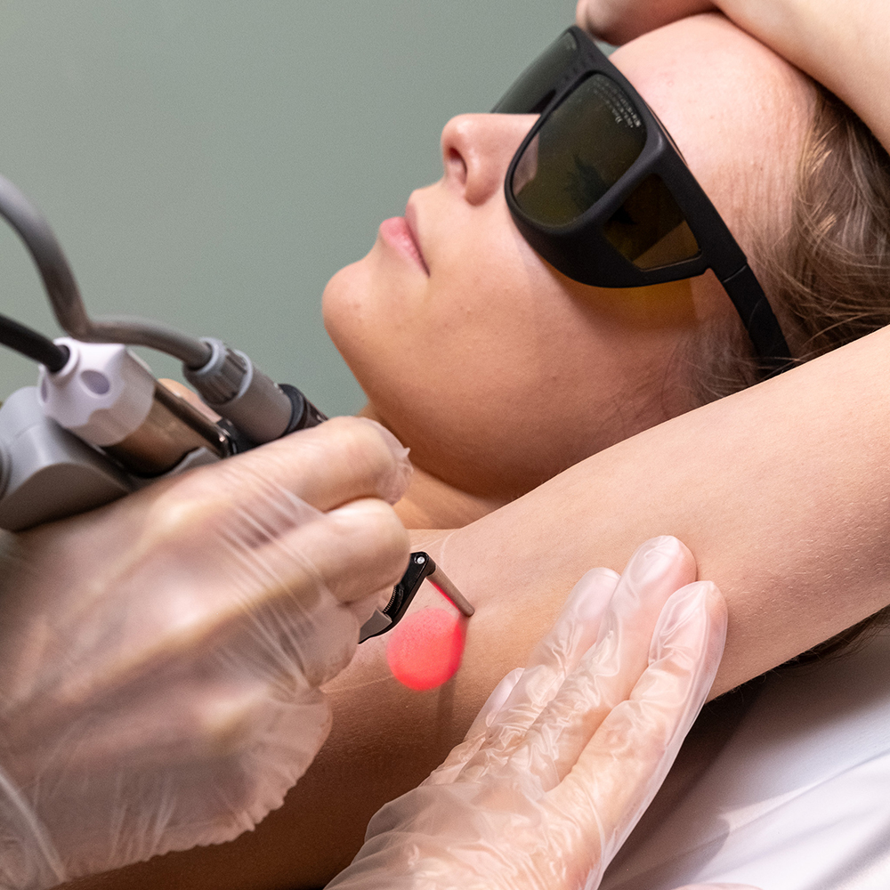 Laser hair removal on armpits
