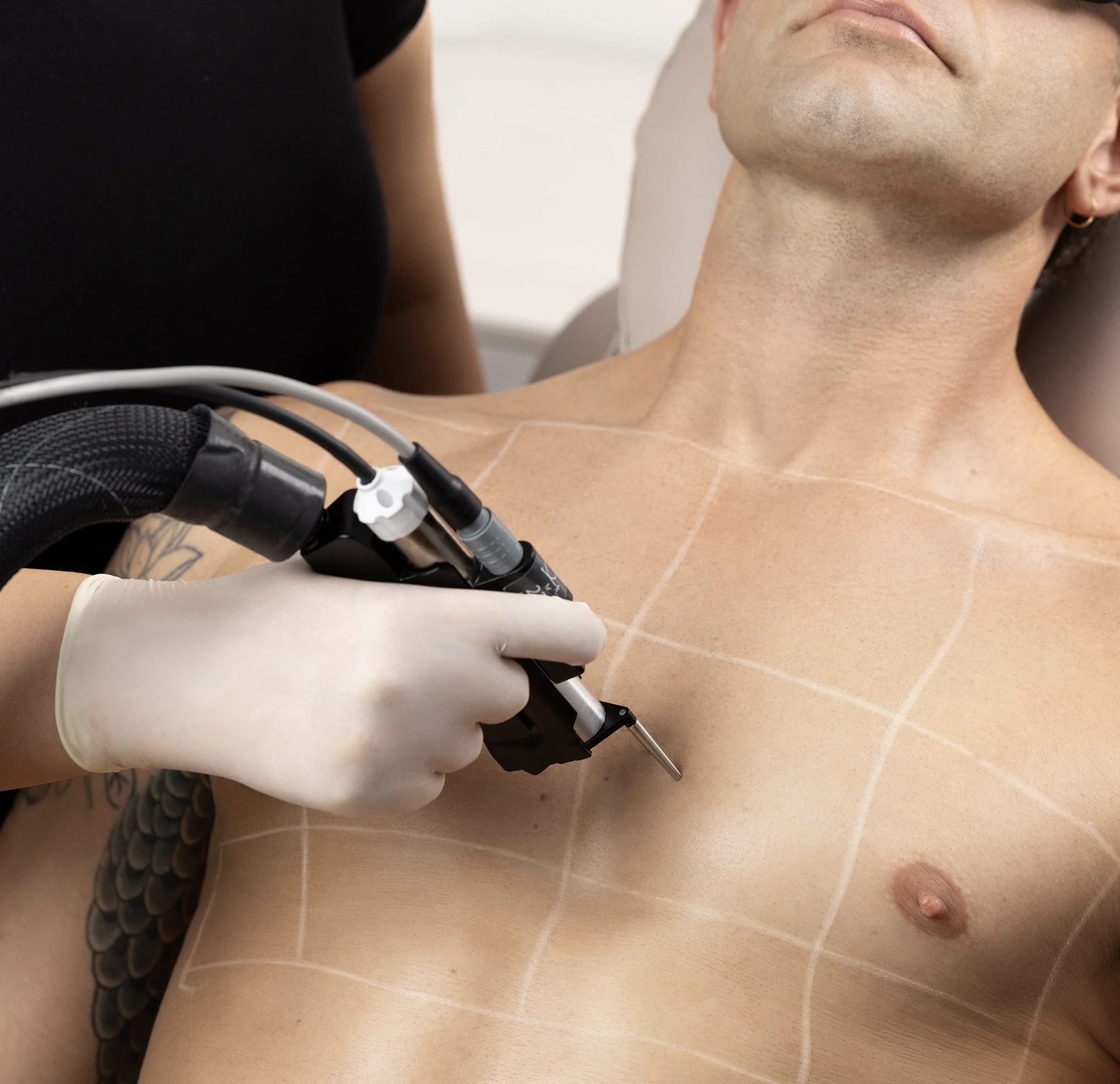 laser hair removal on man's chest