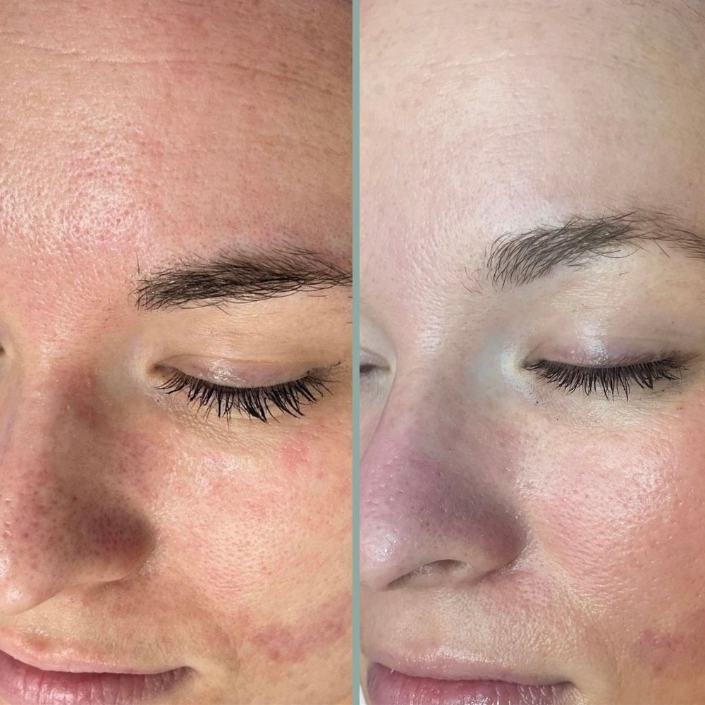 microneedling results