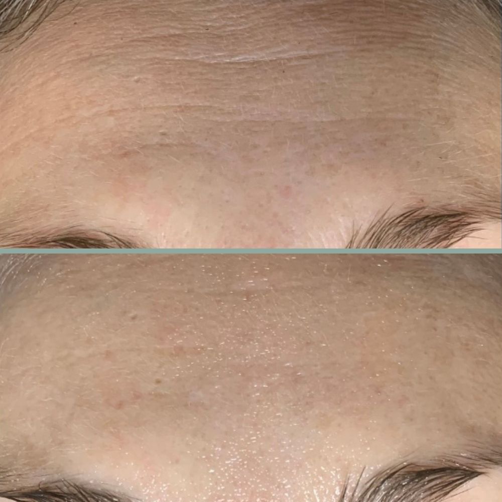 microneedling results