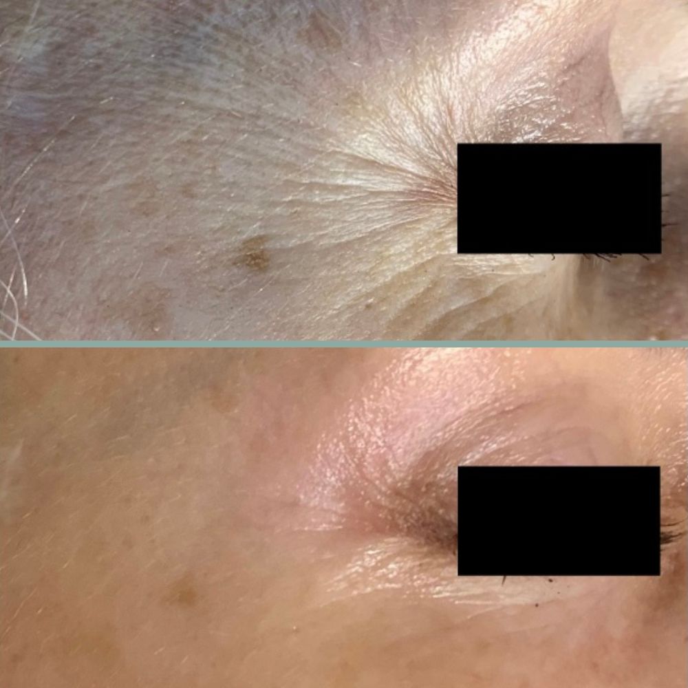microneedling results