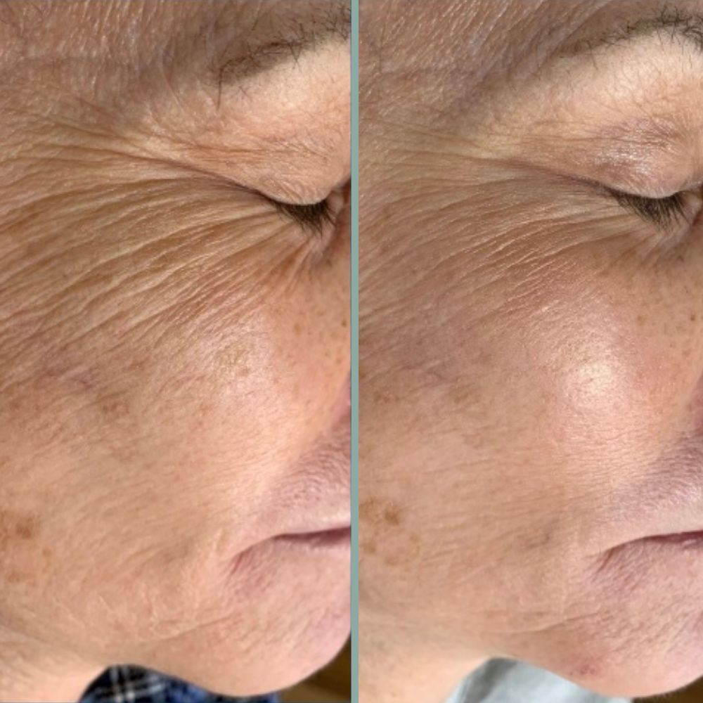 microneedling results