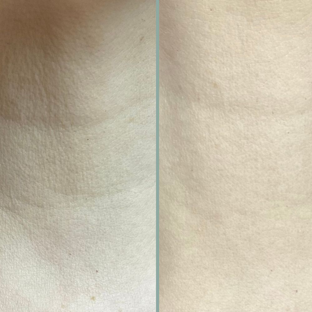 microneedling results