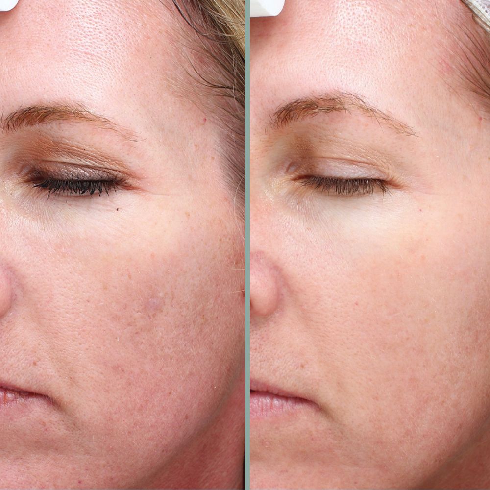 microneedling results