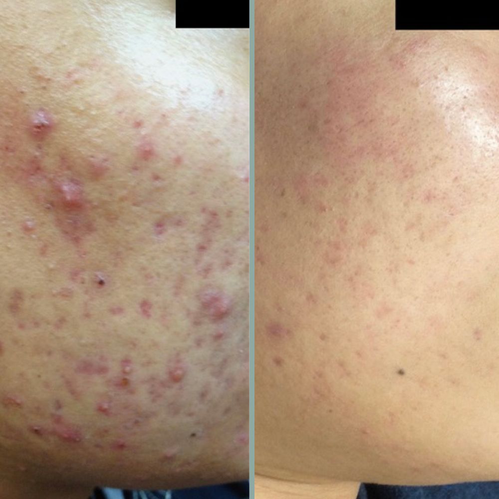 microneedling results