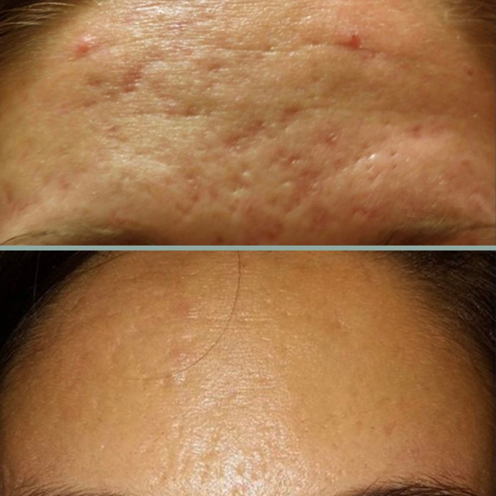 microneedling results