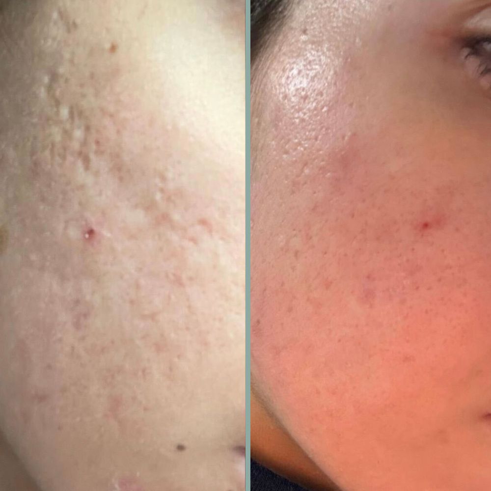 microneedling results