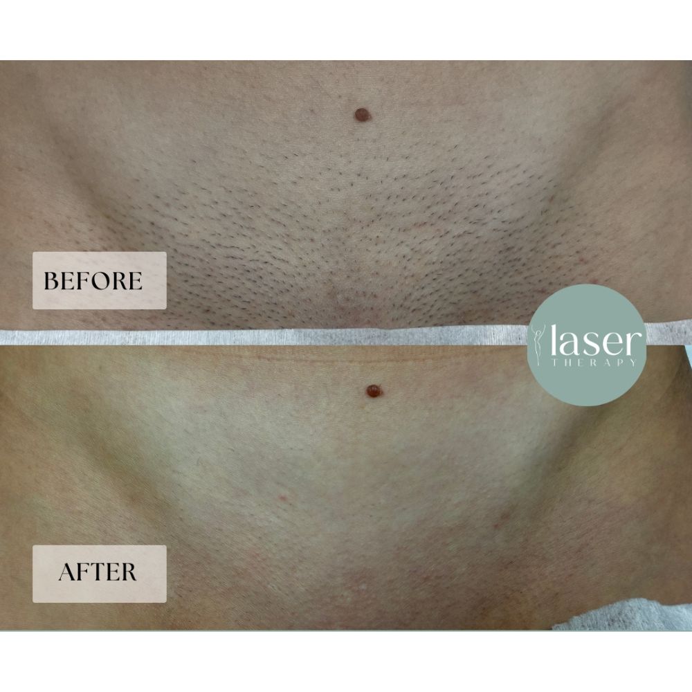 Laser therapy results on body