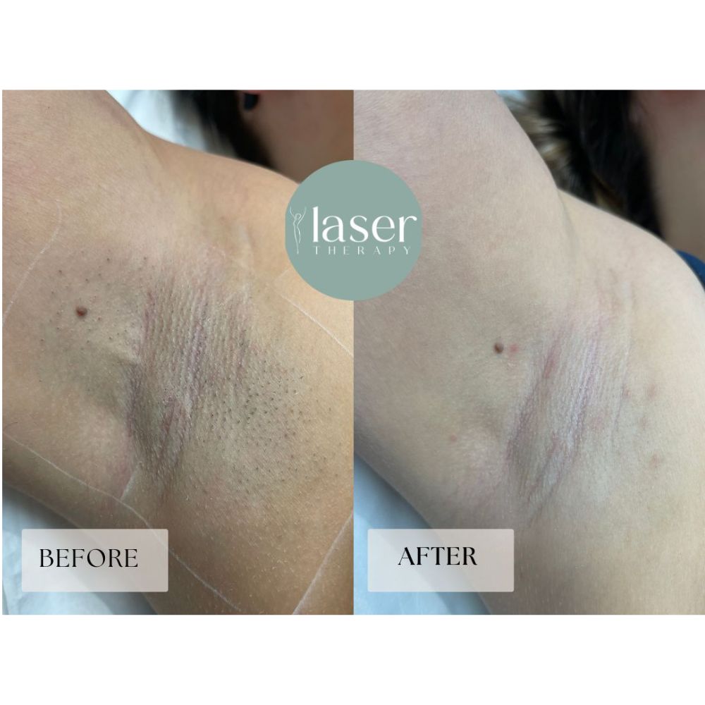 Laser therapy results on body