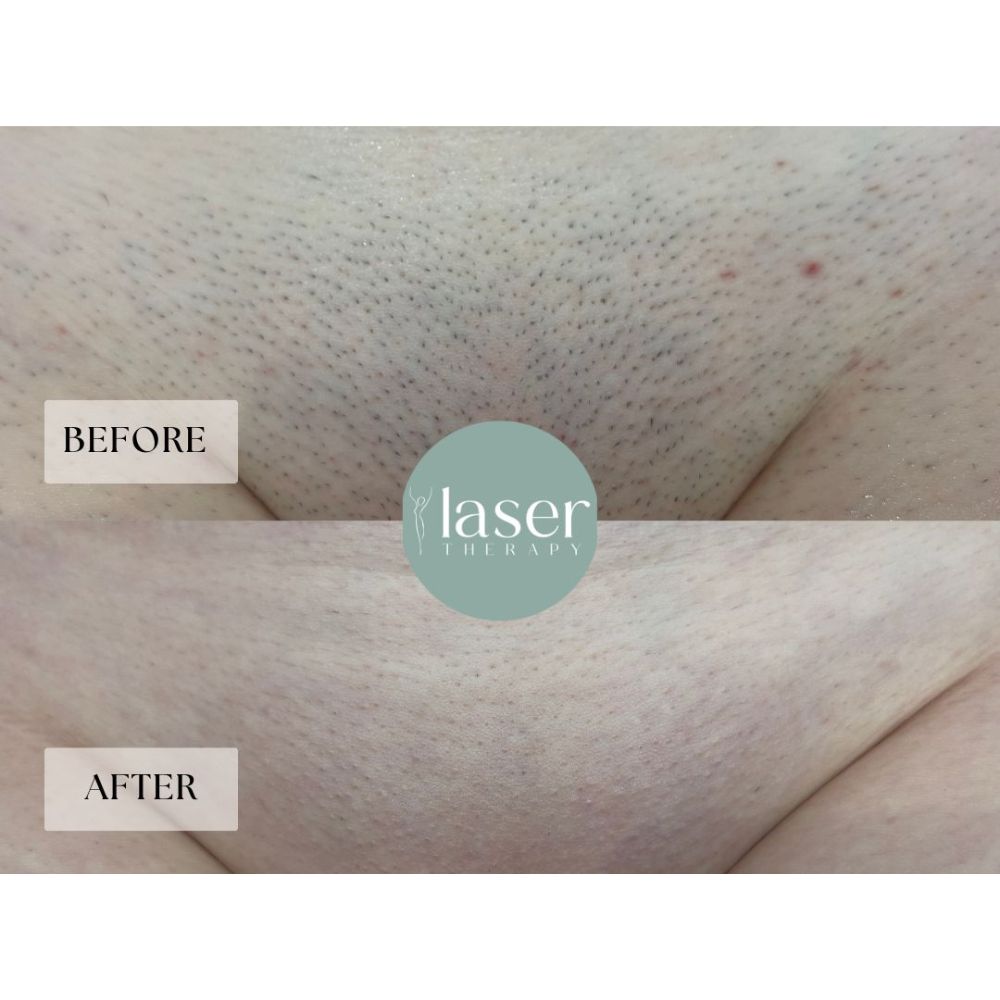 Laser therapy results on body