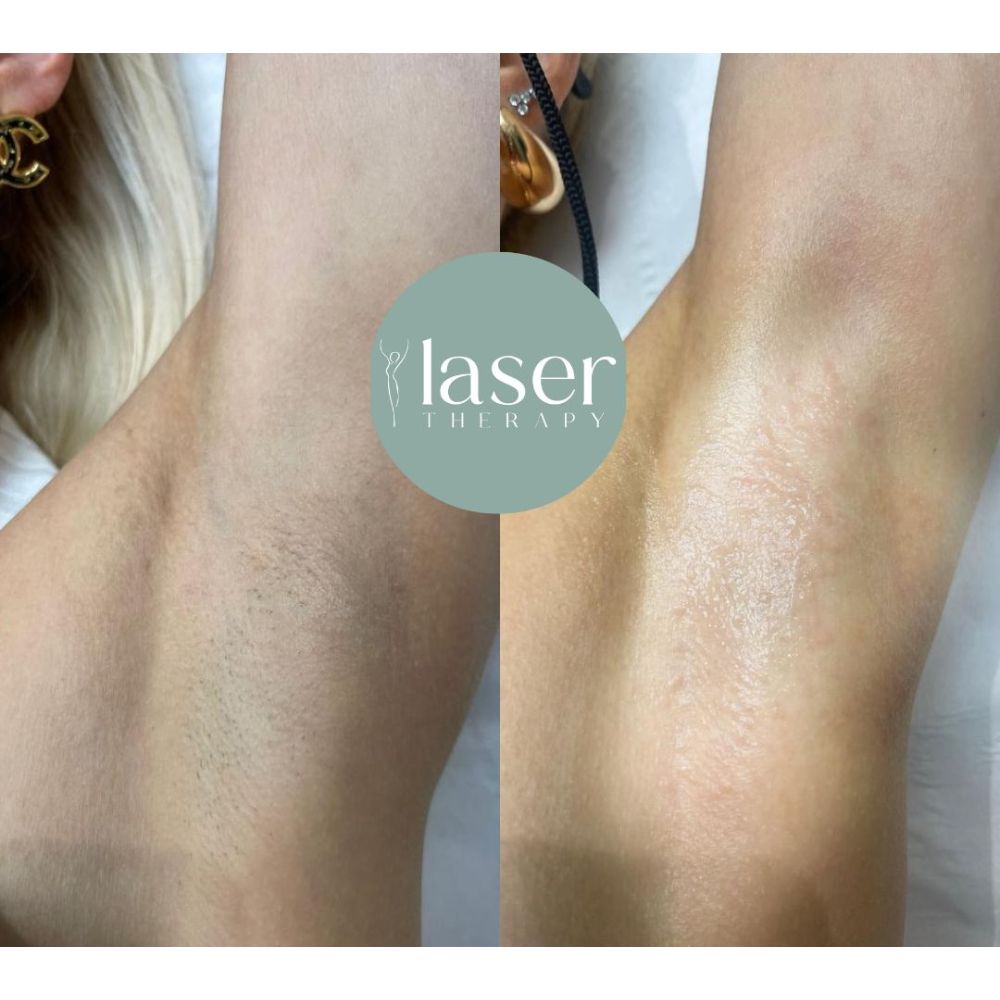 Laser therapy results on body