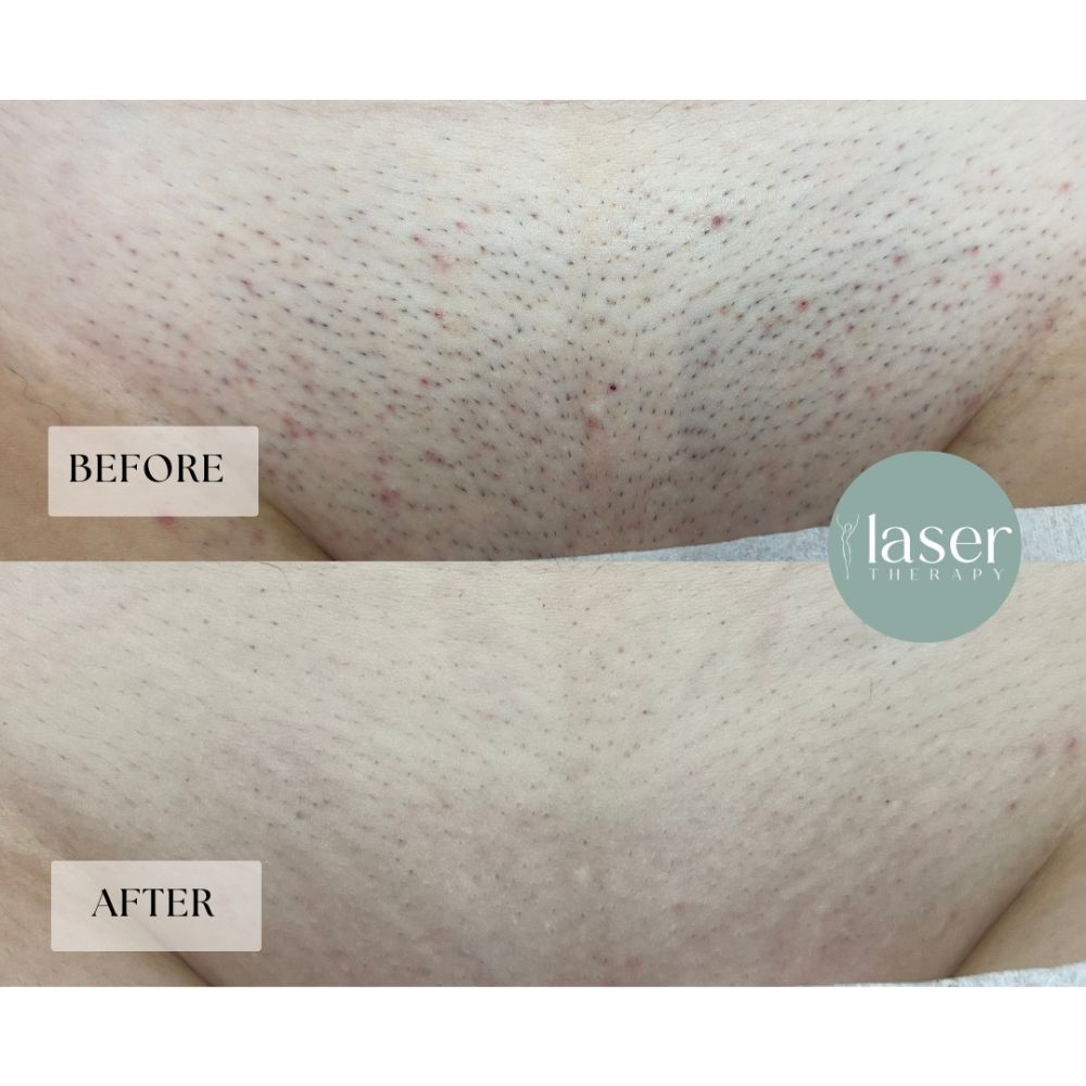Laser therapy results on body