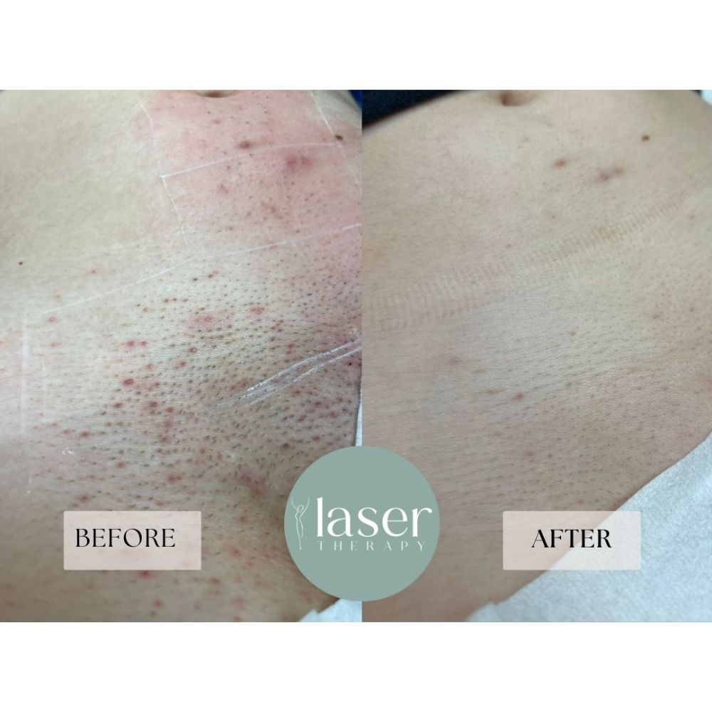 Laser therapy results on body