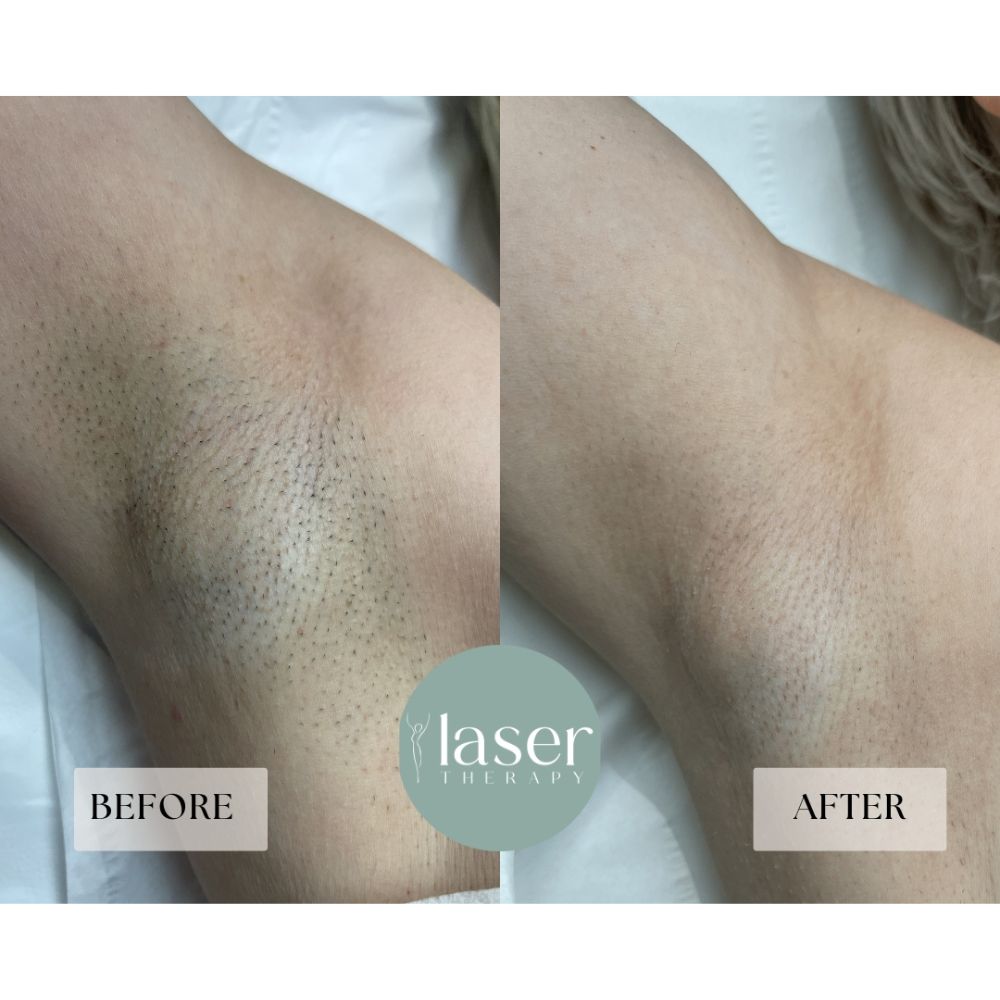 Laser therapy results on body