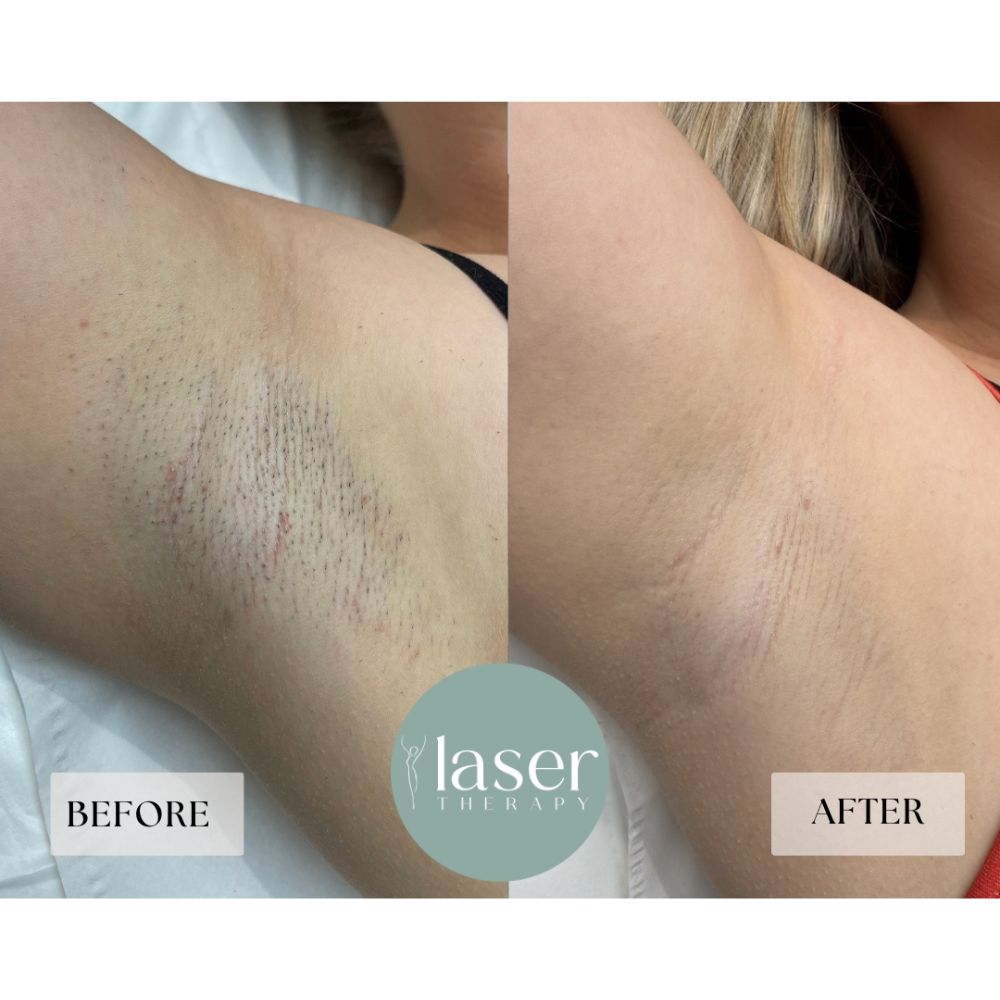 Laser therapy results on body