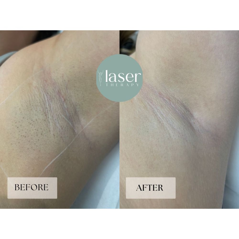 Laser therapy results on body