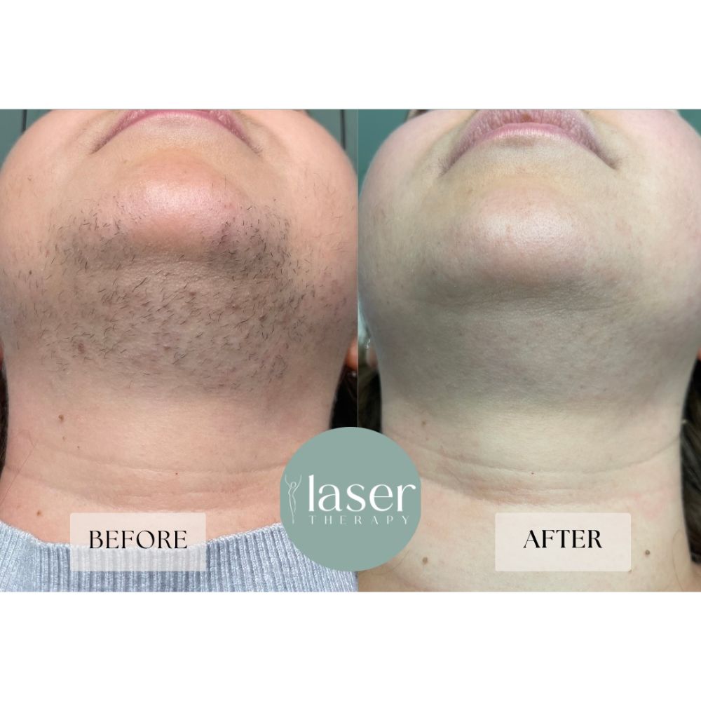 Face laser therapy results