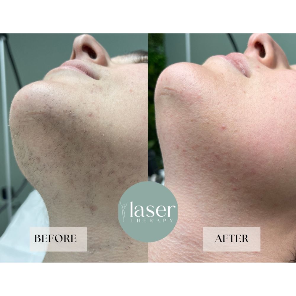 Face laser therapy results