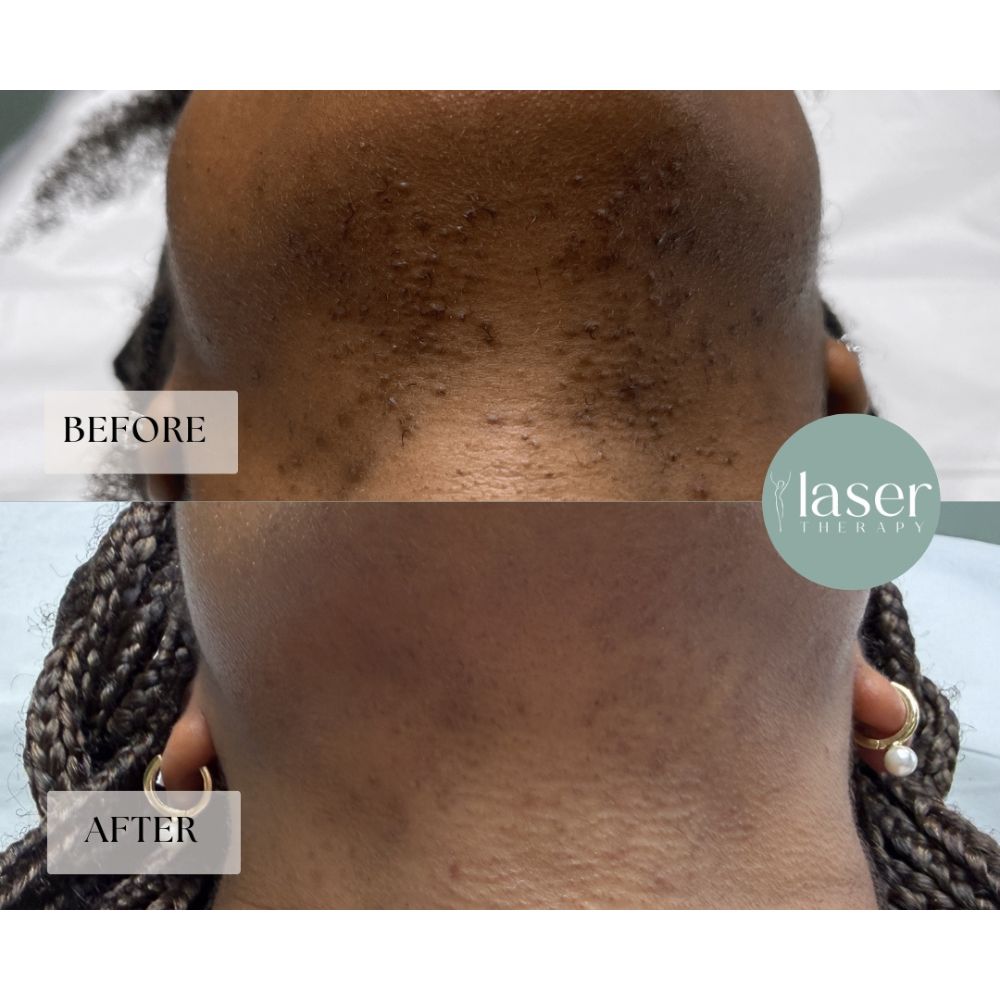 Face laser therapy results