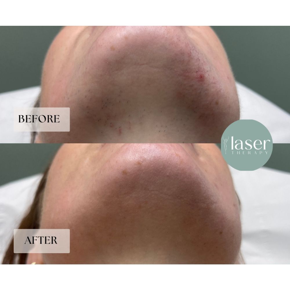 Face laser therapy results