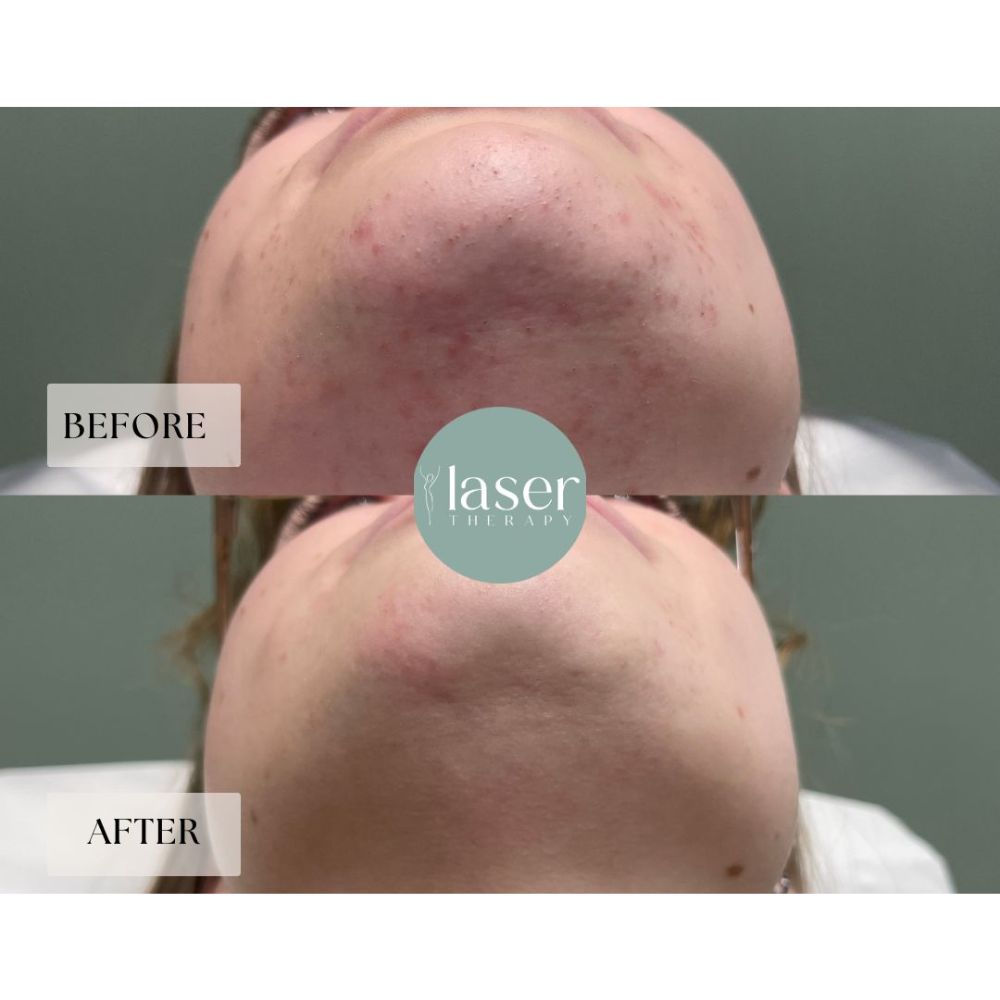 Face laser therapy results