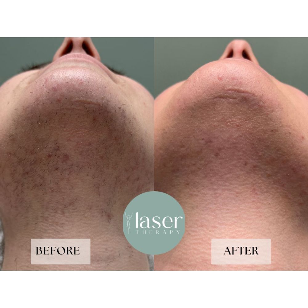 Face laser therapy results