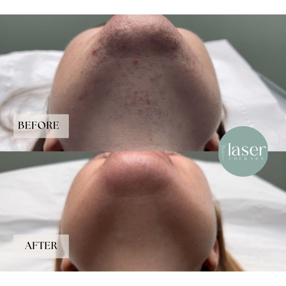 Face laser therapy results