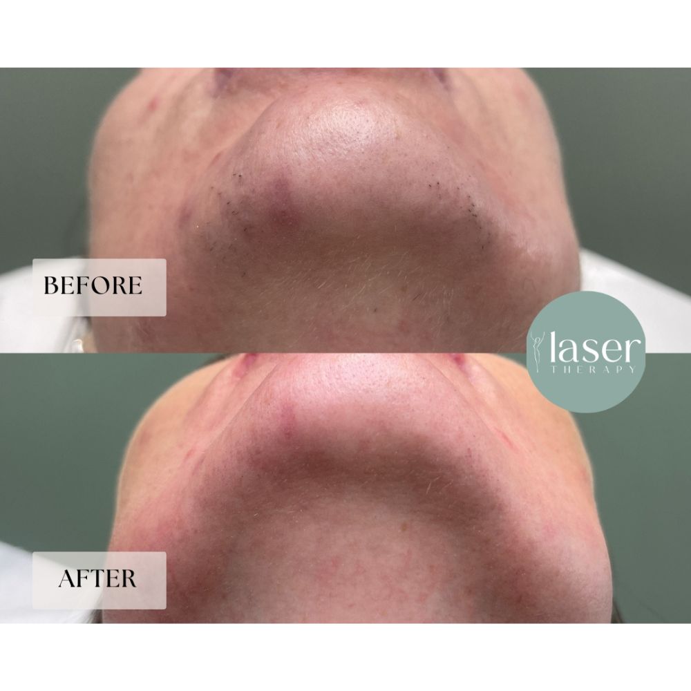 Face laser therapy results