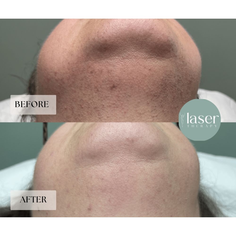Face laser therapy results