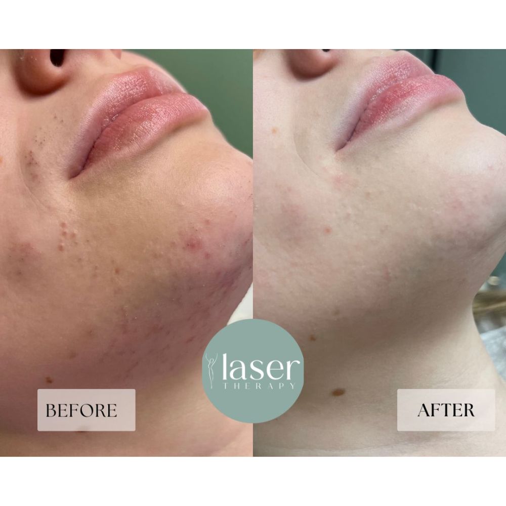 Face laser therapy results