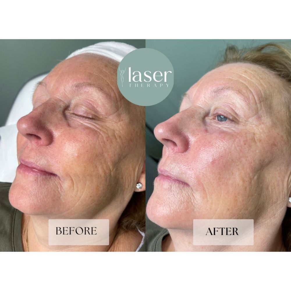 Laser skin rejuvenation treatment