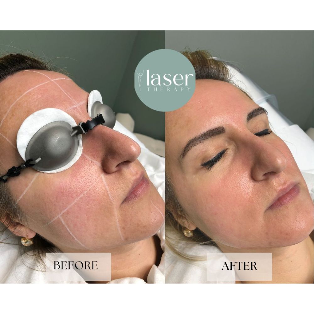 Laser skin rejuvenation treatment